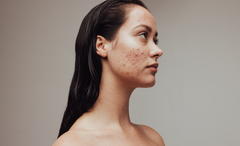 Treating Acne with Red Light Therapy: Does it Really Work?