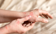 How Red Light Therapy Helps Psoriasis: Natural Anti-Inflammatory