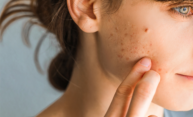 Acne &amp; acne scars